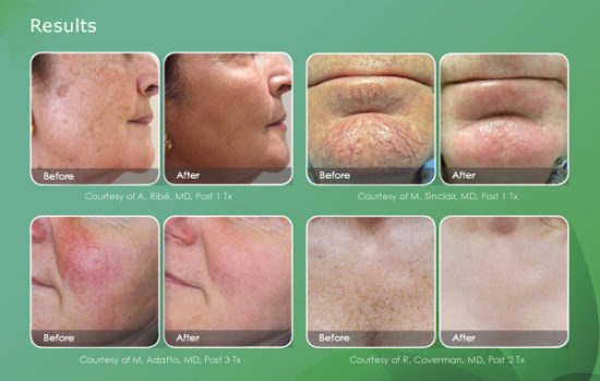 skin-revitalization-email-results-600x385-2-550x350 - Forever Young Salon and Spa Edmonton, Alberta